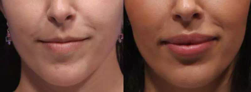 جوانسازی صورت و تزریق چربی به گونه